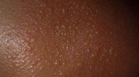 why is my sunburn leaking yellow|Sun Blister: Symptoms, Causes, Diagnosis, and。